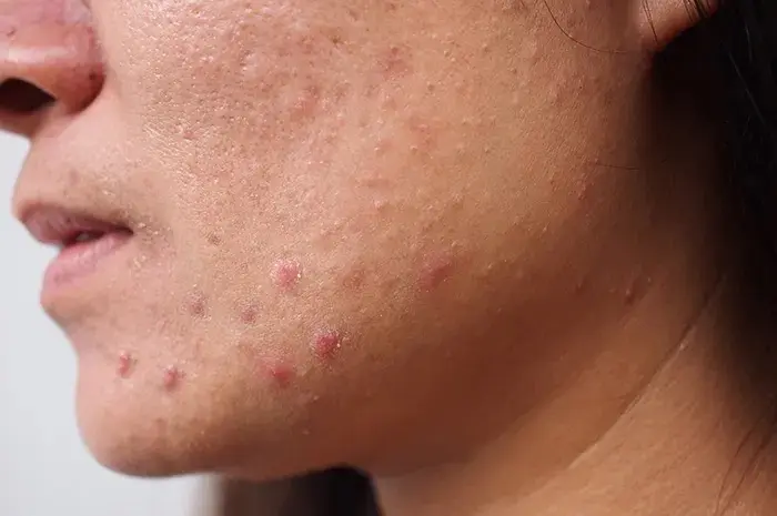 Cara Menghilangkan Bruntusan